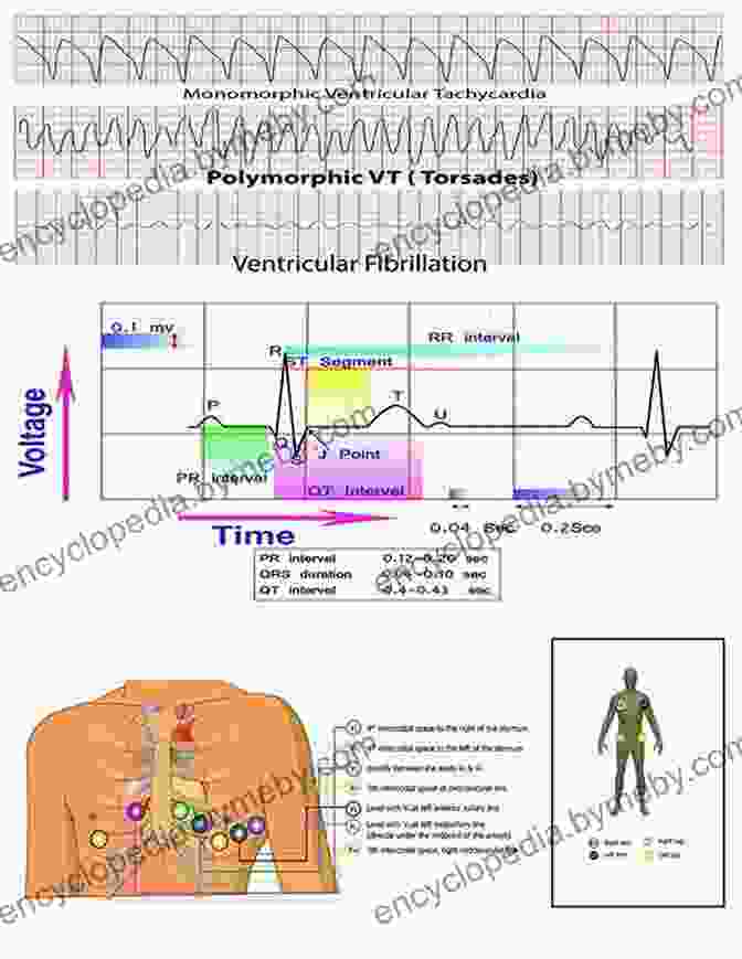 Cover Of 12 Lead EKG For Nurses Book 12 Lead EKG For Nurses: Simple Steps To Interpret Rhythms Arrhythmias Blocks Hypertrophy Infarcts Cardiac Drugs